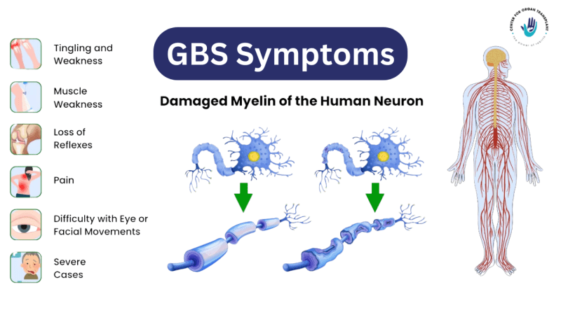 “Guillain-Barré Syndrome Cases Surge To 101 In Pune”